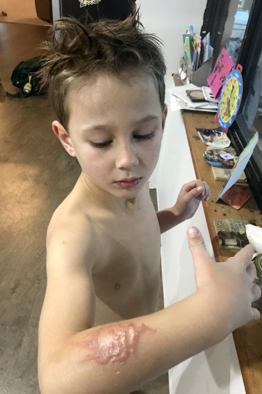 Un baietel, in agonie dupa ce un tatuaj cu henna i-a lasat cicatrici pe viata | Demamici.ro