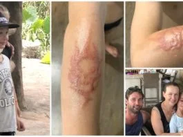 Un baietel, in agonie dupa ce un tatuaj cu henna i-a lasat cicatrici pe viata | Demamici.ro