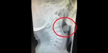 O mama trage un semnal de alarma, dupa ce copilul ei era sa moara din cauza unei boabe de strugure | Demamici.ro