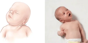Totul despre torticolis la nou-născuți. Cauze si remedii | Demamici.ro