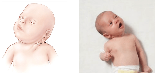 Totul despre torticolis la nou-născuți. Cauze si remedii | Demamici.ro