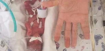 Bebelus nascut la 23 de saptamani lupta pentru viata. Micutul a avut la nastere 368 grame | Demamici.ro