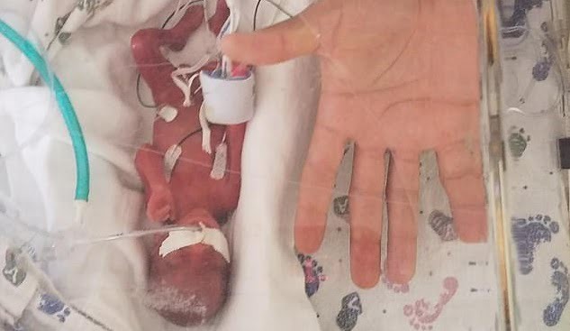 Bebelus nascut la 23 de saptamani lupta pentru viata. Micutul a avut la nastere 368 grame | Demamici.ro