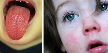 Ce este scarlatina si cum se trateaza | Demamici.ro