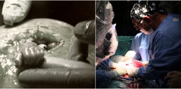 Copil nenascut, operat in uter, il prinde de deget pe chirurg | Demamici.ro