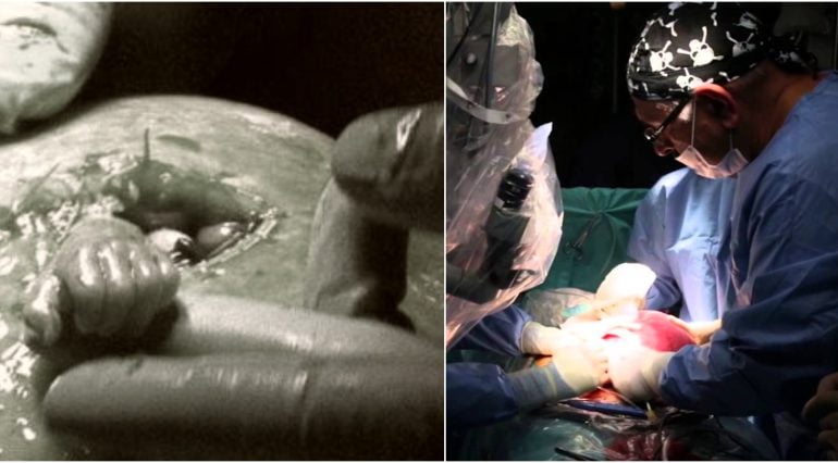 Copil nenascut, operat in uter, il prinde de deget pe chirurg | Demamici.ro
