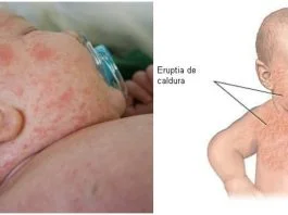 Bubitele de la caldura. Cum le recunosti si cum se pot trata | Demamici.ro