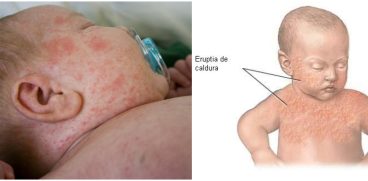 Bubitele de la caldura. Cum le recunosti si cum se pot trata | Demamici.ro