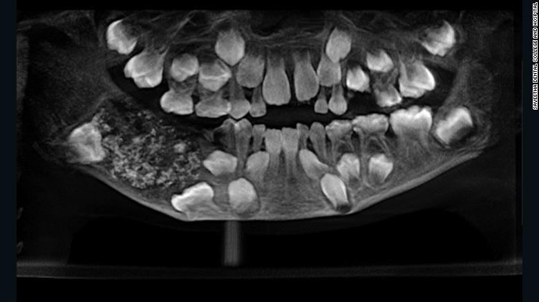 Doctorii au găsit 526 de dinți