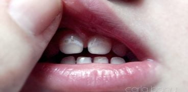 Demineralizarea dintilor de lapte. Care sunt cauzele si cum se previne | Demamici.ro