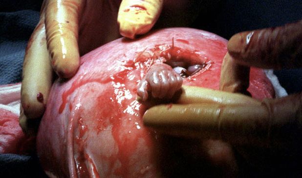 Copil nenascut, operat in uter, il prinde de deget pe chirurg | Demamici.ro