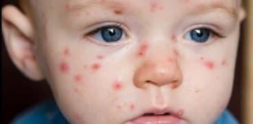 Ce trebuie sa stii despre cele mai frecvente boli ale copilariei: rujeola, varsat de vant, tuse magareasca si alte boli transmisibile | Demamici.ro