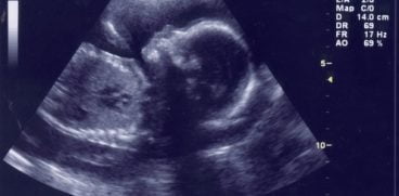 Particule de carbon, gasite in placenta gravidelor. Cum sunt afectati bebelusii de aerul poluat | Demamici.ro