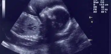 Particule de carbon, gasite in placenta gravidelor. Cum sunt afectati bebelusii de aerul poluat | Demamici.ro