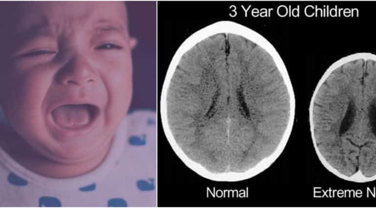 Cum arata creierul unui copil abuzat si neglijat de parinti. Imagini surprinse la tomograf | Demamici.ro
