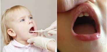 Herpangina. Cauze, simptome si tratament | Demamici.ro