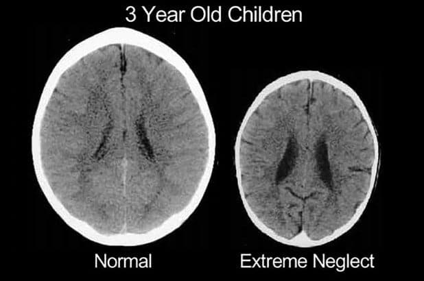 Cum arata creierul unui copil abuzat