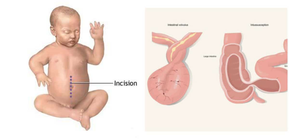 Ocluzie intestinala, confundata cu gastroenterita. Asa a murit o fetita de 2 anisori | Demamici.ro