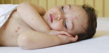 Rujeola la copii sterge memoria sistemului imunitar. Riscuri majore pentru copil | Demamici.ro