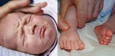 Profilaxia rahitismului. Ce este rahitismul – simptome, cauze si tratament | Demamici.ro