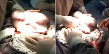 Un bebelus s-a nascut in sacul amniotic. Caz de 1 la 80.000 de nasteri VIDEO | Demamici.ro
