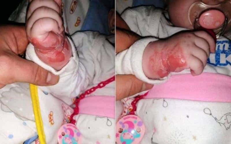 Bebelus de 5 luni, plin de rani in spital dupa ce a facut alergie la leucoplast | Demamici.ro