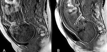 Capul copilului isi modifica forma radical in timpul nasterii naturale | Demamici.ro