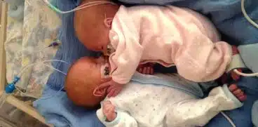 Bebelusi gemeni, nascuti prematur la 23 de saptamani, salvati de neonatologi. Cantareau doar 500 de grame | Demamici.ro