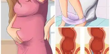 Hemoroizii in sarcina. Cauze si tratament | Demamici.ro