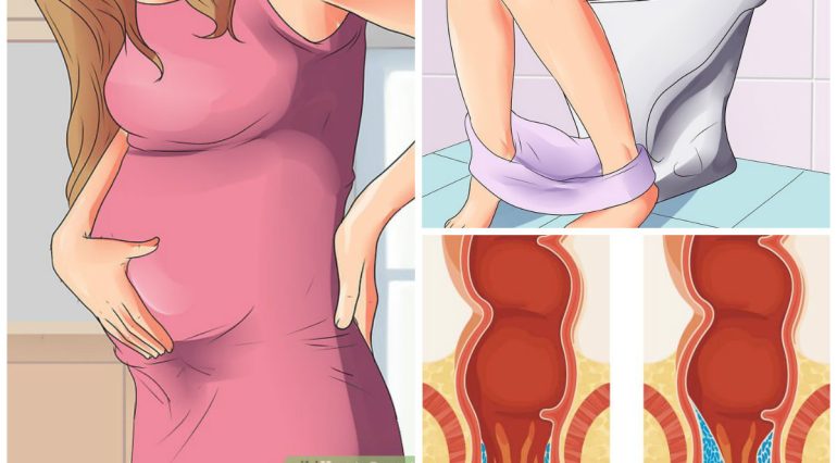 Hemoroizi in sarcina