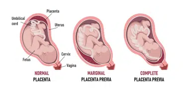 Placenta: rolul ei in sarcina si afectiuni care pot aparea | Demamici.ro