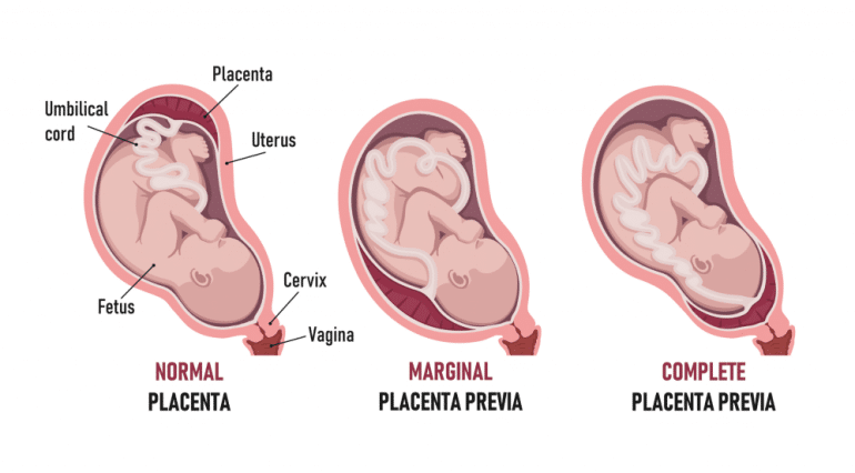 Placenta: rolul ei si afectiuni ale placentei | Demamici.ro
