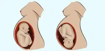 Prezentatia pelviana a copilului. De ce fatul”nu se intoarce” | Demamici.ro