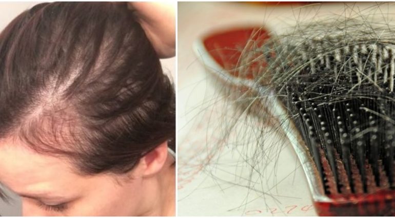 Căderea părului după naștere. Remedii naturale | Demamici.ro