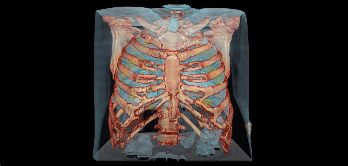 Cum arata plamanii unui pacient infectat cu COVID-19. Imagini 3D VIDEO | Demamici.ro