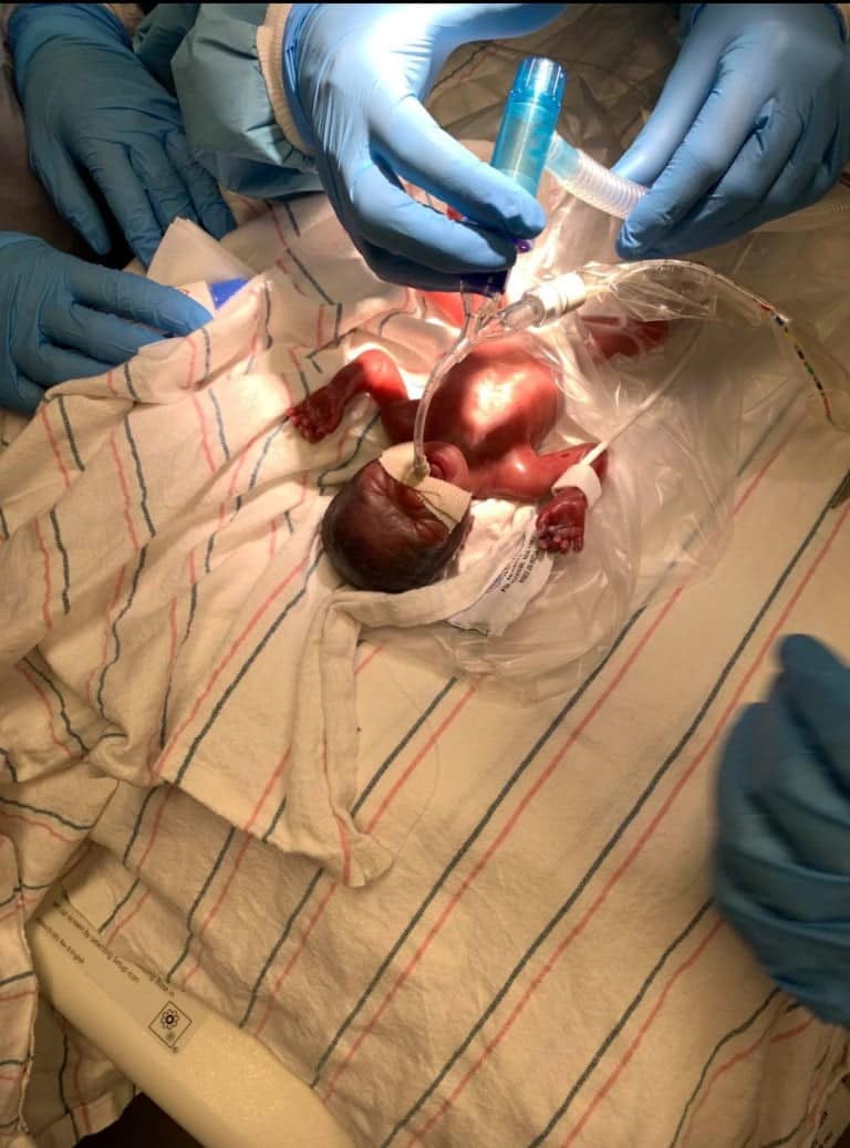 Al doilea caz in lume. Gemene nascute prematur la 22 de saptamani reusesc in mod miraculos sa supravietuiasca