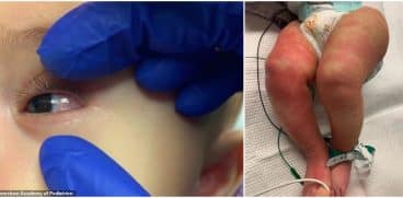 Bebeluș de 6 luni: primul caz de COVID-19 și boala Kawasaki în același timp | Demamici.ro