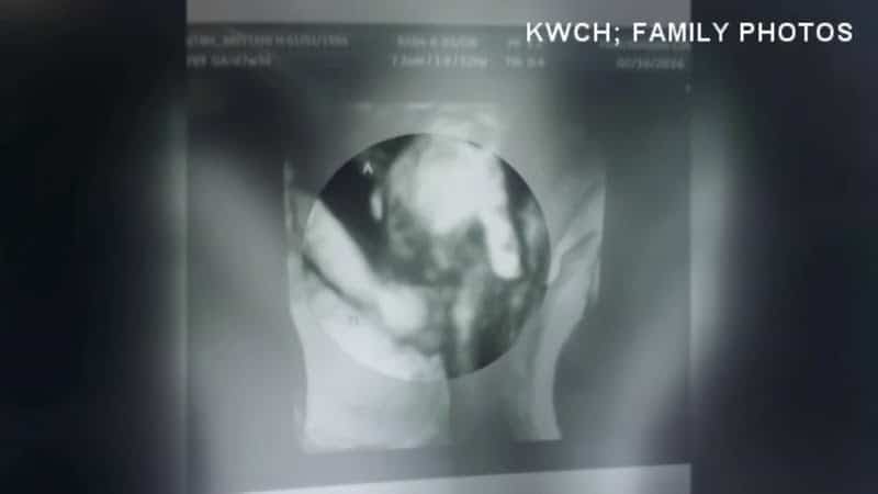 Un făt bolnav a fost surprins la ecograf în timp ce strângea mâna surorii gemene