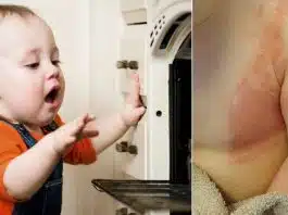 Primul ajutor în cazul arsurilor la copii! Sfaturile unei mame care a trecut prin asta | Demamici.ro
