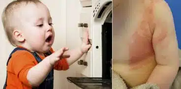 Primul ajutor în cazul arsurilor la copii! Sfaturile unei mame care a trecut prin asta | Demamici.ro
