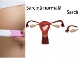 Sarcina extrauterină (ectopică). Cauze, simptome și tratament | Demamici.ro