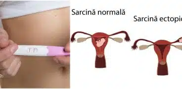 Sarcina extrauterină (ectopică). Cauze, simptome și tratament | Demamici.ro