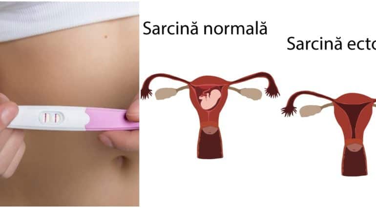 Sarcina extrauterină (ectopică). Cauze, simptome și tratament | Demamici.ro