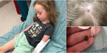 O fetiță  de 5 ani a paralizat temporar pe partea stângă și nu a mai putut vorbi 12 ore, după ce a fost mușcată de o căpușă | Demamici.ro