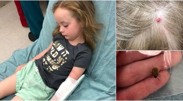 O fetiță de 5 ani a paralizat temporar pe partea stângă și nu a mai putut vorbi 12 ore, după ce a fost mușcată de o căpușă | Demamici.ro
