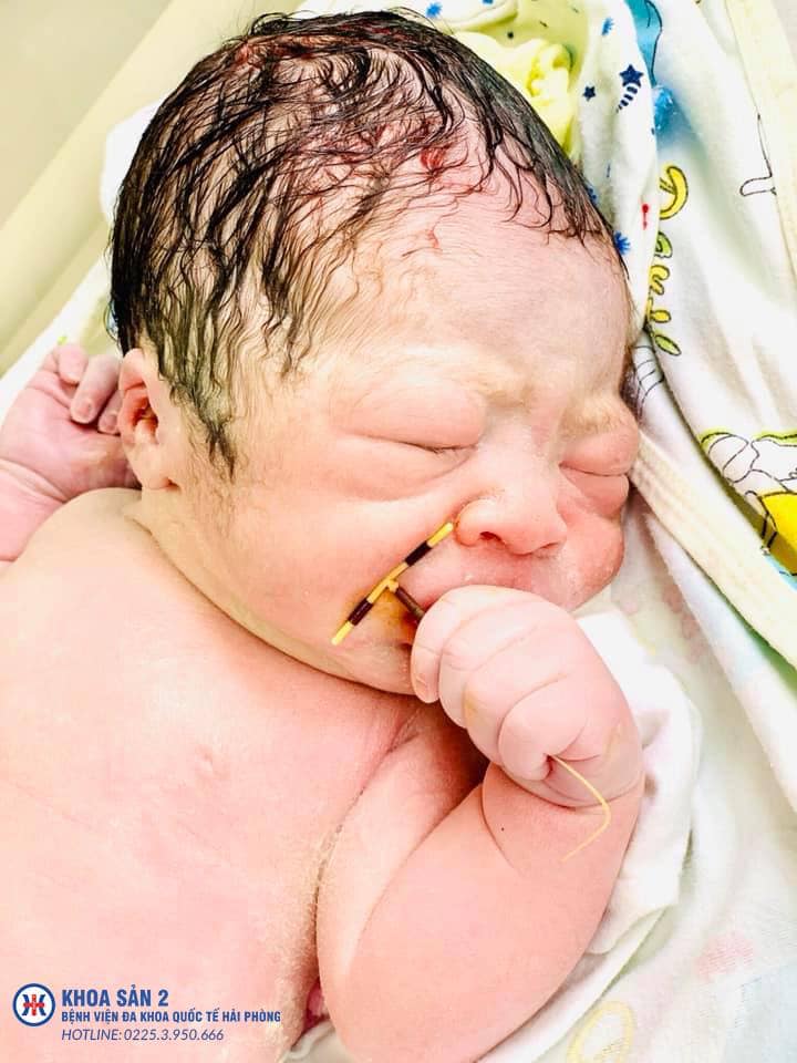 Un bebeluș a venit pe lume cu o "surpriză" în mână: steriletul mamei sale