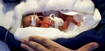S-a născut cât o palmă de om, iar medicii nu credeau că va supraviețui. Povestea celei mai mici fetițe, care s-a născut în Asia | Demamici.ro