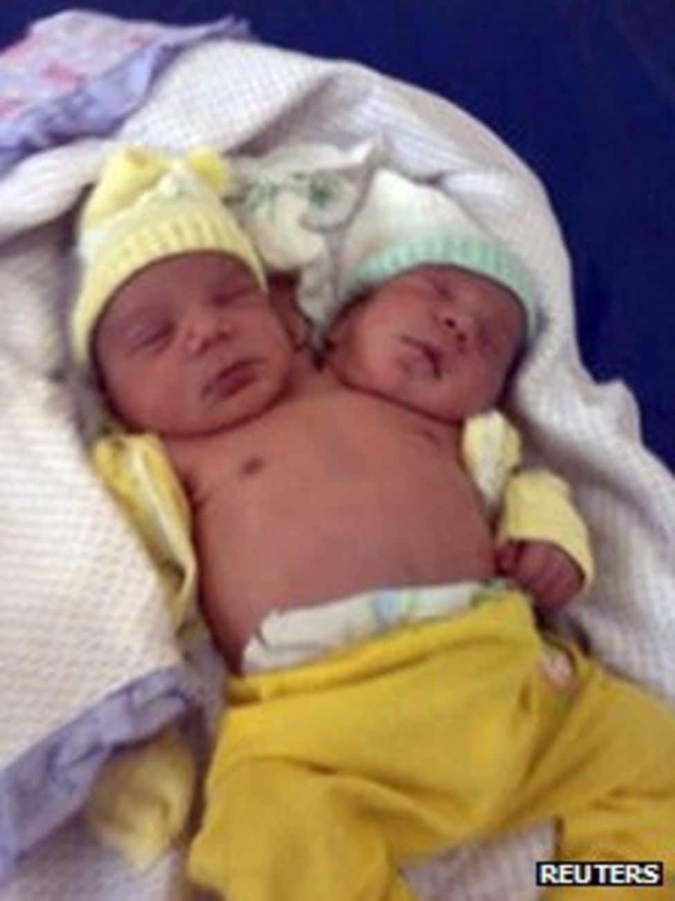 Bebeluși cu două capete. Cazurile medicale care au uluit lumea