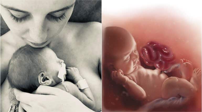 A aflat la naștere că băiețelul are intestinele în afara abdomenului și 10% șanse să trăiască! Poveste relatată de „mămica unui copil malformat” | Demamici.ro