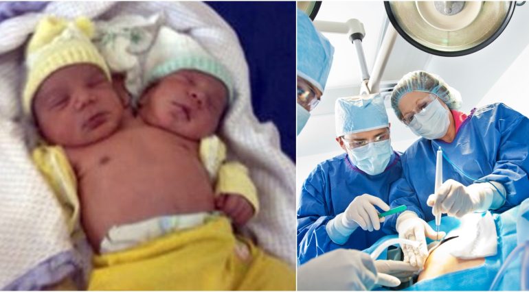 Bebeluși cu două capete. Cazurile medicale care au uluit lumea | Demamici.ro